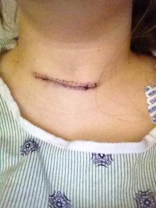 Parathyroid Surgery 